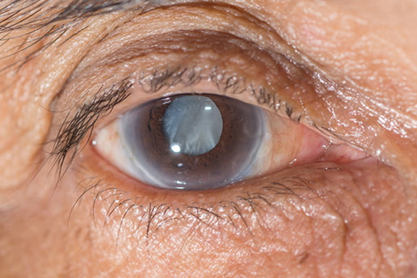 Cataract Eye Surgery