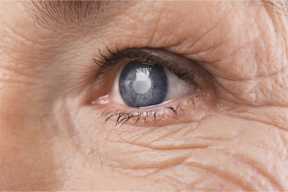 Best Doctor For Glaucoma Treatment In Delhi